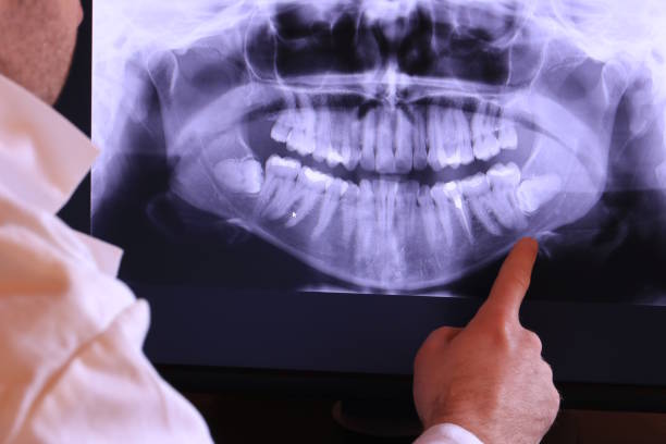 Best Emergency Wisdom Teeth Removal in Washington, MO