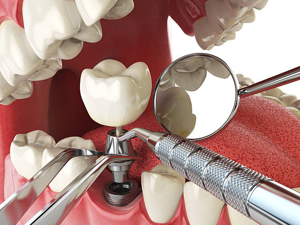 Best Emergency Gum Treatment in Washington, MO
